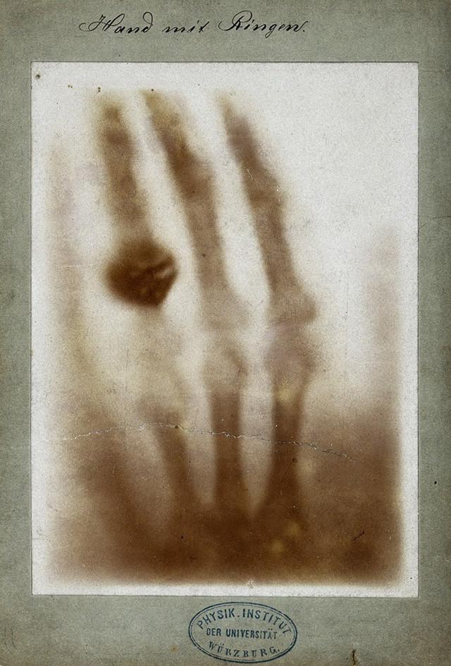 Mano con anillo, una de las primeras radiografías médicas, por Wilhem Röntgen. Imagen de la mano izquierda de su esposa, Anna Bertha Ludwig. 22 de diciembre de 1895